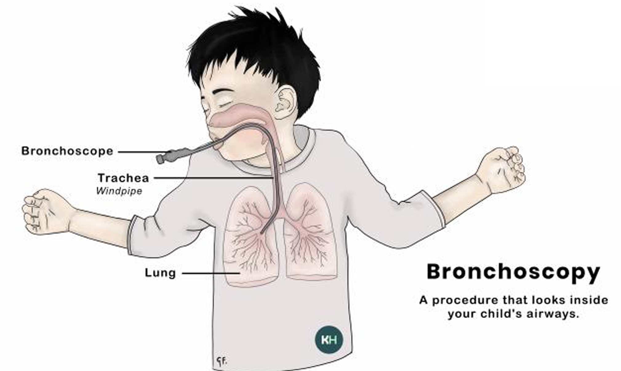 Bronchoscopy procedure