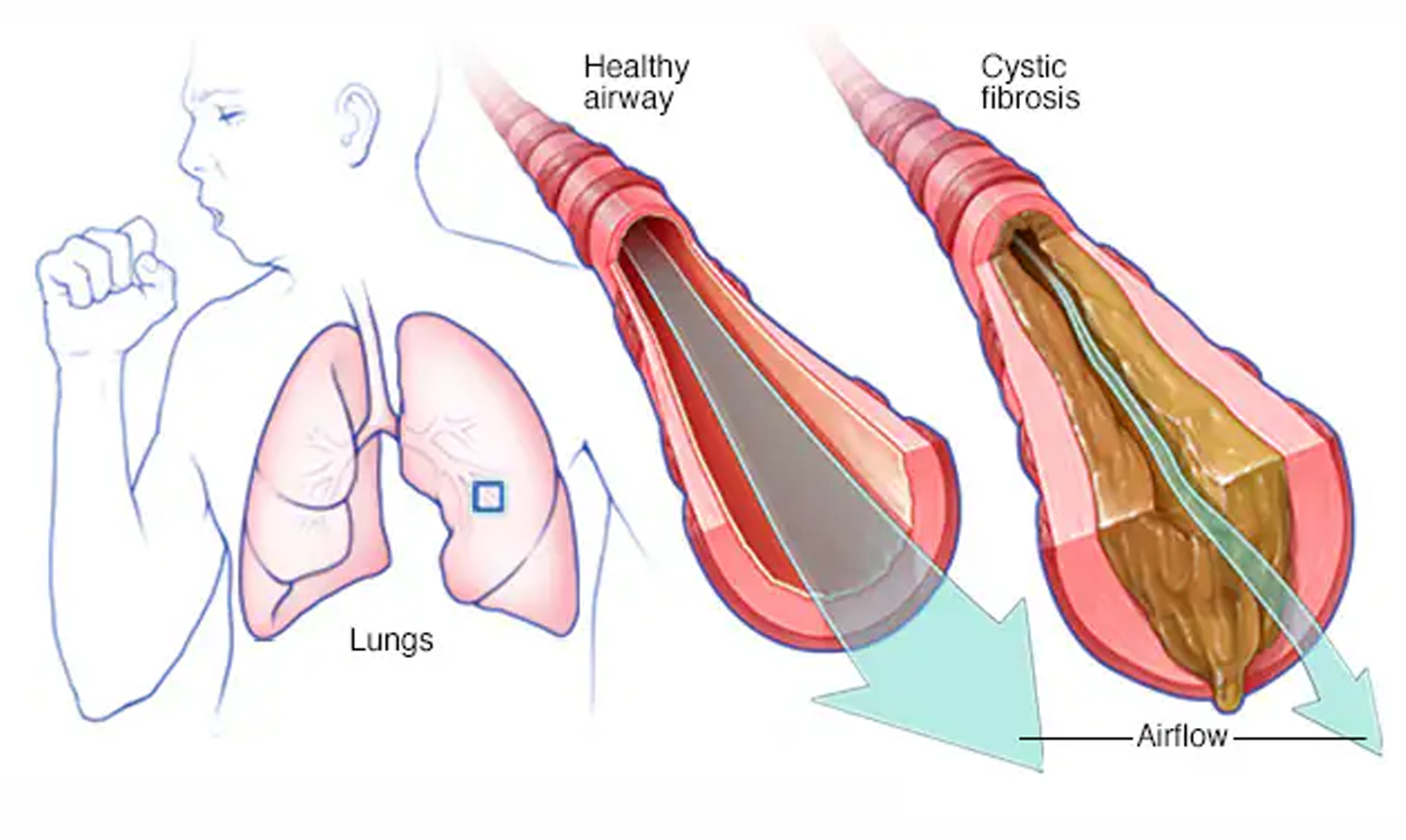 Cystic Fibrosis Care