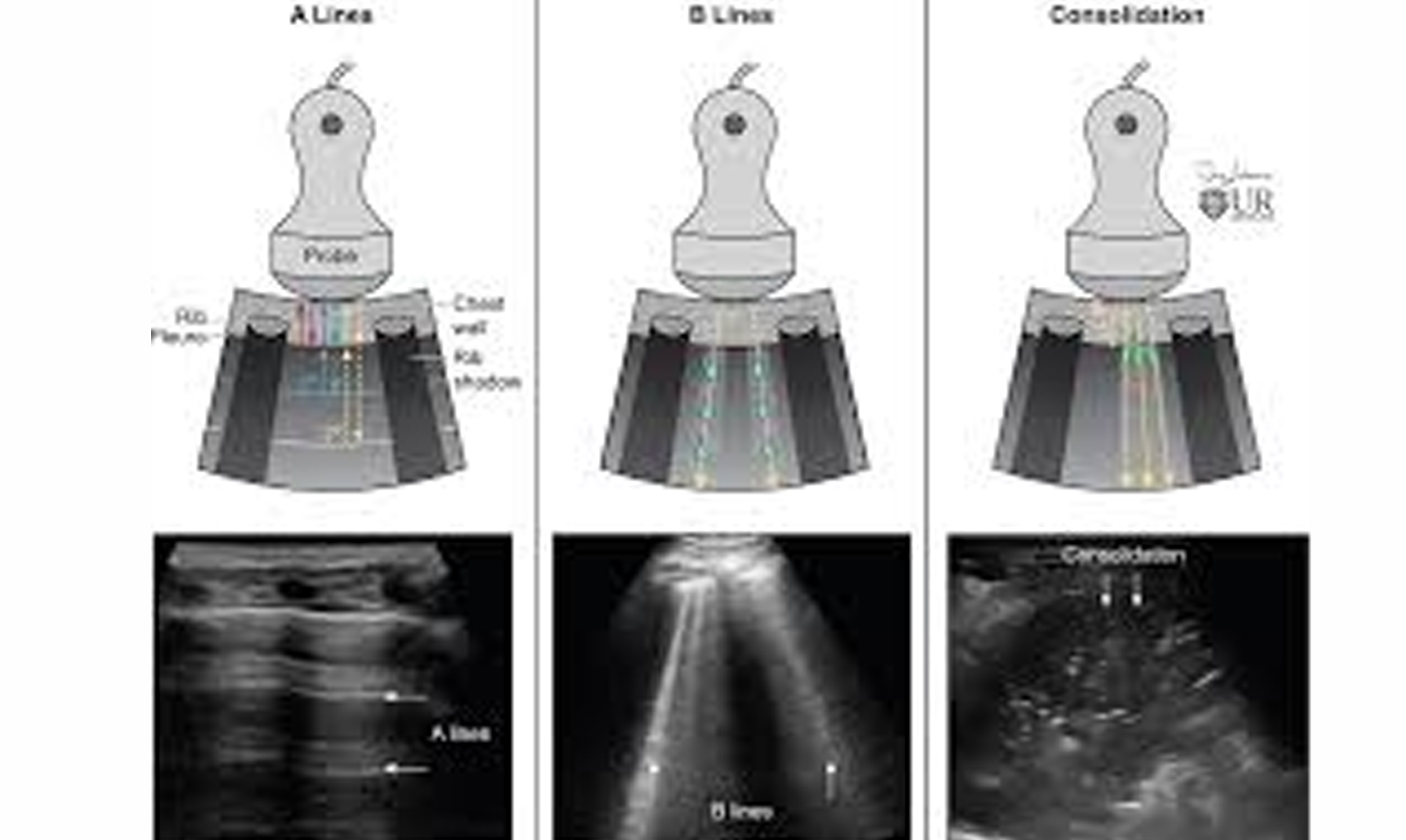 Lung ultrasound imaging