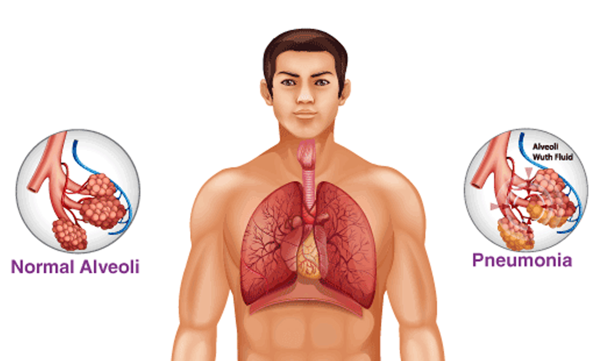 Pneumonia Care