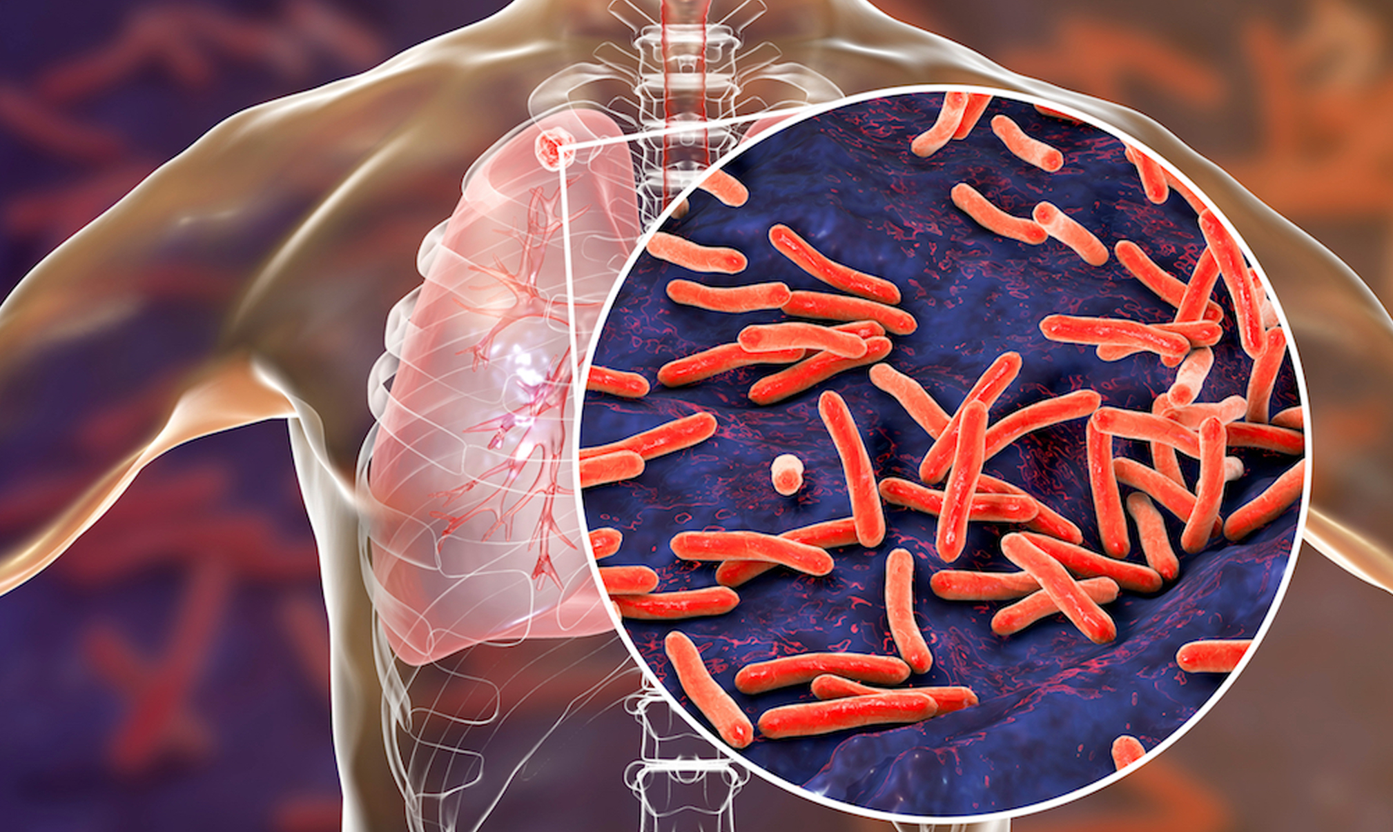 Tuberculosis care